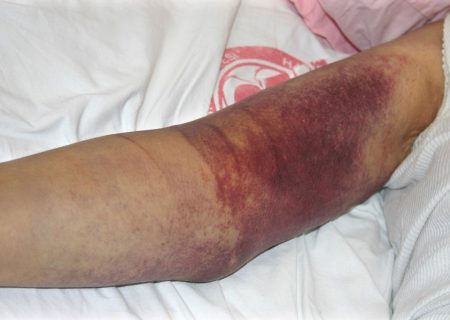 فوت یک بیمار مبتلا به تب “کریمه کنگو” در فارس
