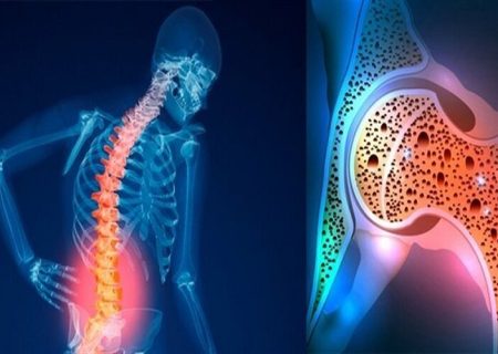 پوکی استخوان؛ بیماری خاموش اما قابل پیشگیری