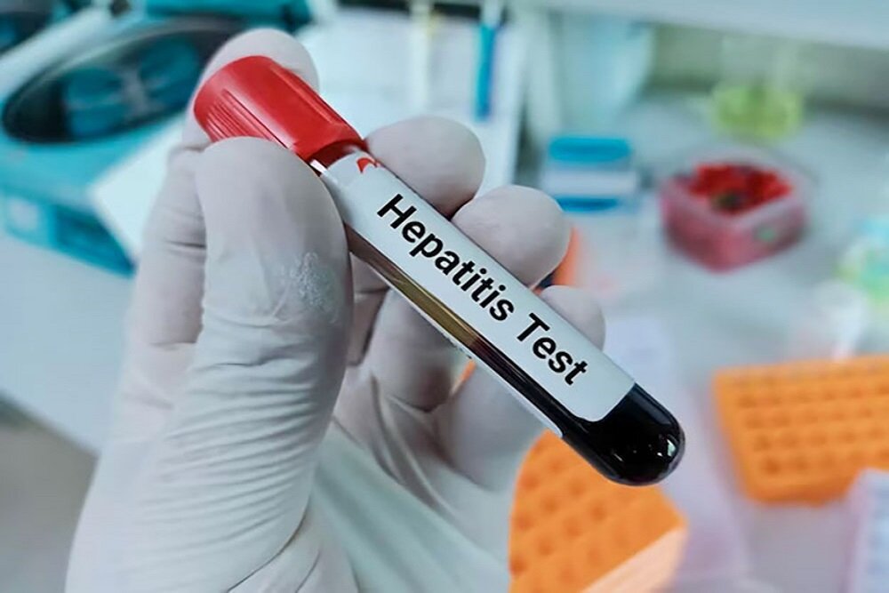 برنامه‌های غربالگری بیماری هپاتیت C در فارس گسترش می‌یابد