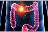 چرایی بروز سرطان روده بزرگ و علائم ابتلا به آن