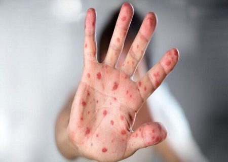 بیماری سرخک را بیشتر بشناسیم