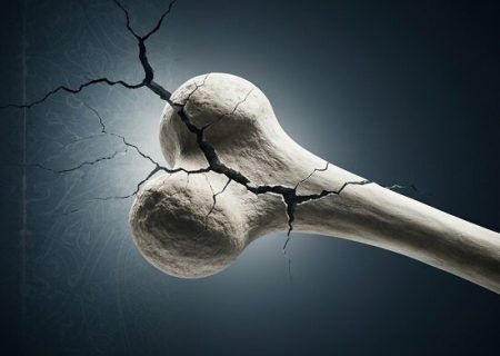 پیشگیری از سقوط و شکستگی با ایمن‌سازی فضای خانه