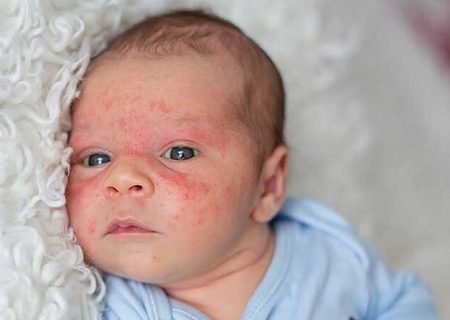 امکان بهبودی اگزمای پوستی نوزادان با افزایش سن